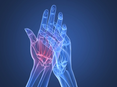 Ревматоиден артрит - причини и лечение