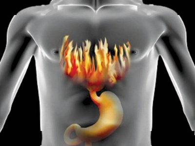 Как да облекчим киселините в стомаха и гастроезофагеалната рефлуксна болест