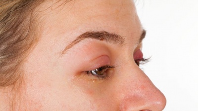 Как да се справим с подпухналите и подути очи?