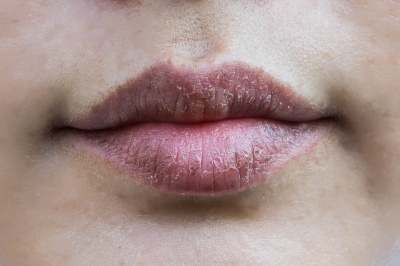Сухите устни - как да ги защитим?