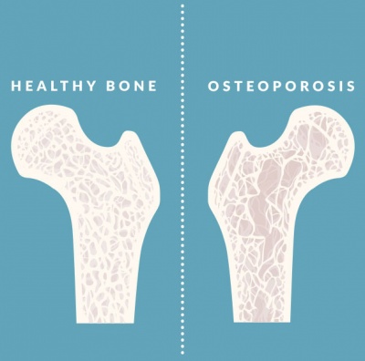 4 стъпки за превенция на остеопороза