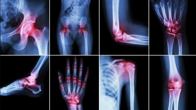 Как да противодействаме на артритни болки с храна?