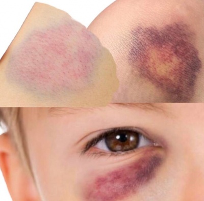 Всичко за натъртванията... и цветовете им