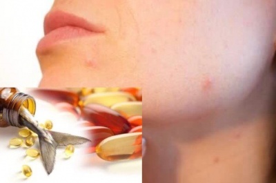 Масло от черен дроб на треска може да е в помощ при акне