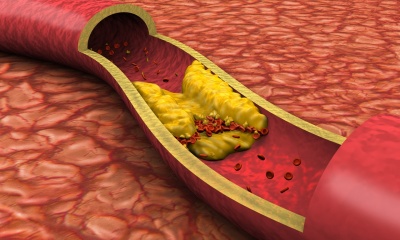 Холестерол - всичко, което трябва да знаете