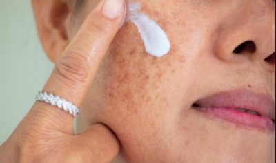Как да се справим със старческите петна по кожата?