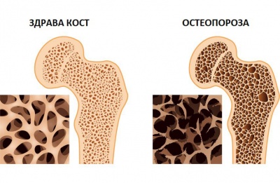 4 стъпки за превенция на остеопороза
