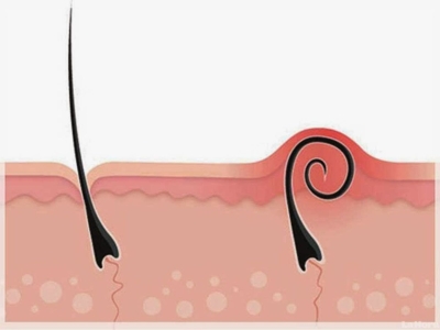 Как да преборим подкожните косъмчета?