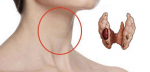 Йодът е тясно свързан със здравето на щитовидната жлеза