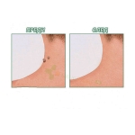 ПЛАСТИР ПРОТИВ БРАДАВИЦИ 30 броя / TELESTAR FORMU CLEAR SKIN TAG PATCH